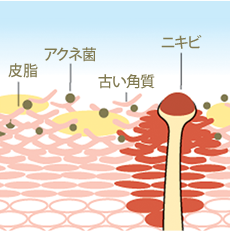 なぜ、ニキビはできるのですか? 角質イメージ